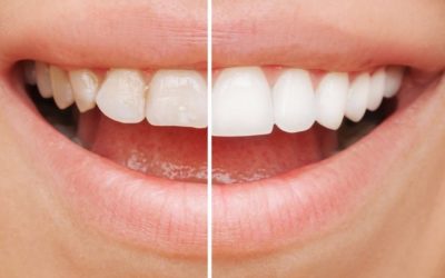 Fixing Uneven Teeth: Cosmetic Dentistry Options for a More Balanced Smile