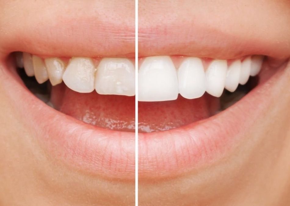 “Long-lasting porcelain veneers on natural teeth after several years of consistent care”