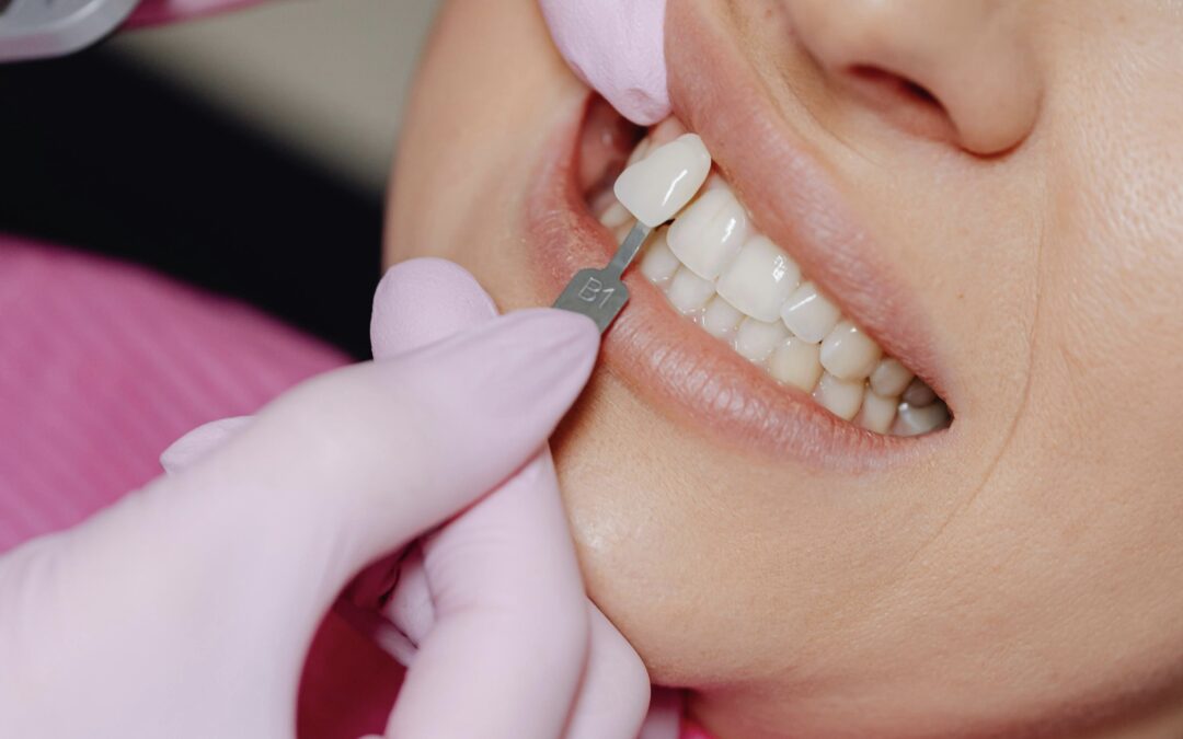 cosmetic dentist matching porcelain veneer shade to a patient's natural teeth during a smile makeover consultation to increase confidence and renew her smile